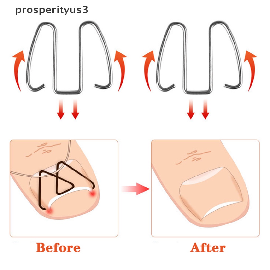 [prosperityus3] Nail Art Ingrown Toe Nail Correction Tool Toenail Nail Orthosis Paronychia Clip [new]