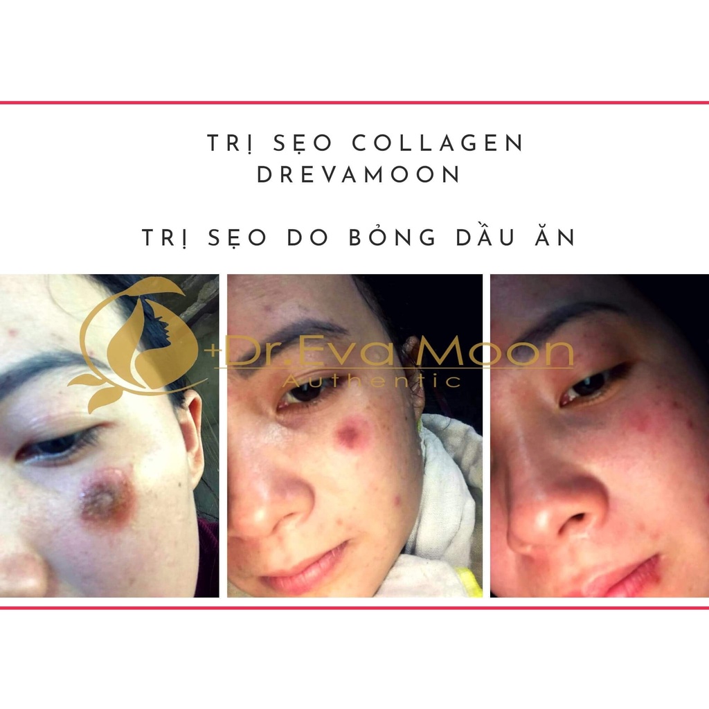 DR EVA cao sẹo collagen handmade