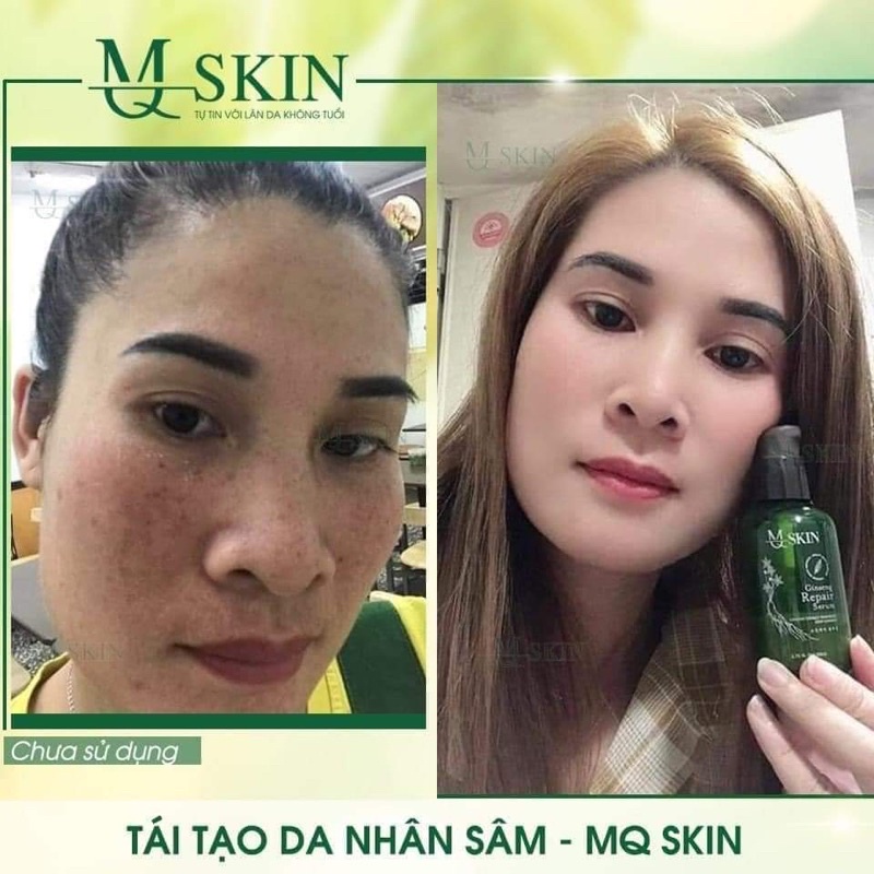 Tái Tạo Da Nhân Sâm Mqskin_serum thay da ngừa mụn, nám tàn nhang, sẹo rỗ