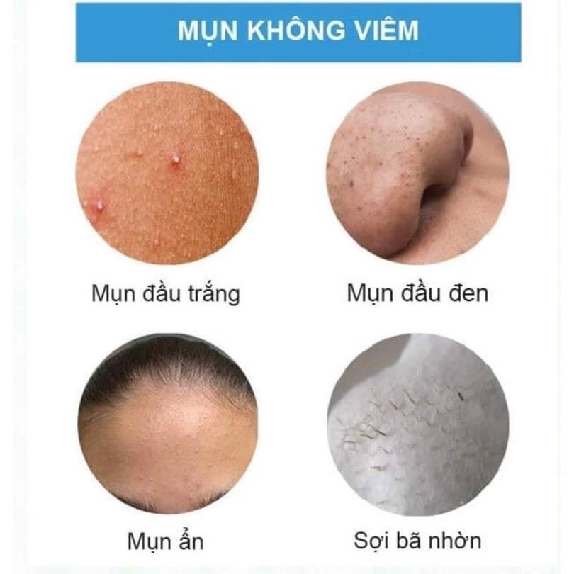 KEM CHẤM MỤN, HỖ TRỢ GIẢM MỤN GOM CỒI MỤN TỨC THÌ, KIỂM SOÁT DẦU THỪA NGĂN NGỪA MỤN QUAY TRỞ LẠI SamBeauty