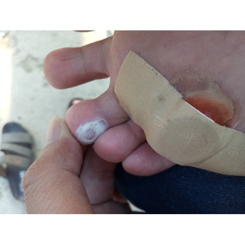 COMBO 2 HỘP 12 MIẾNG DÁN MỤN CƠM MỤN CÓC MẮT CÁ CHÂN hiệu quả cao