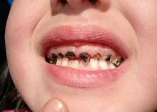 Thuốc chống sún của mỹ