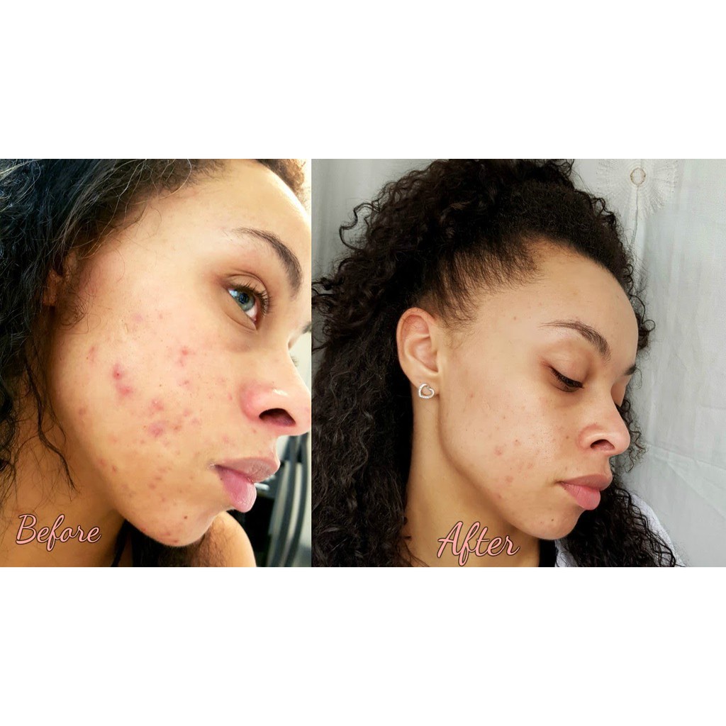 [ ĐỦ BILL] Serum giảm mụn, chống lão hoá The Ordinary Retinol 1% In Squalane | BigBuy360 - bigbuy360.vn