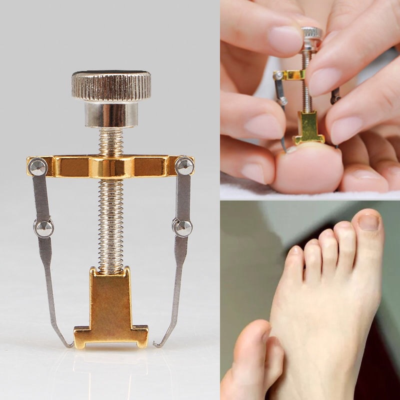 Dụng Cụ Chỉnh Hình Móng Chân Mọc Ngược Móng Quặp
