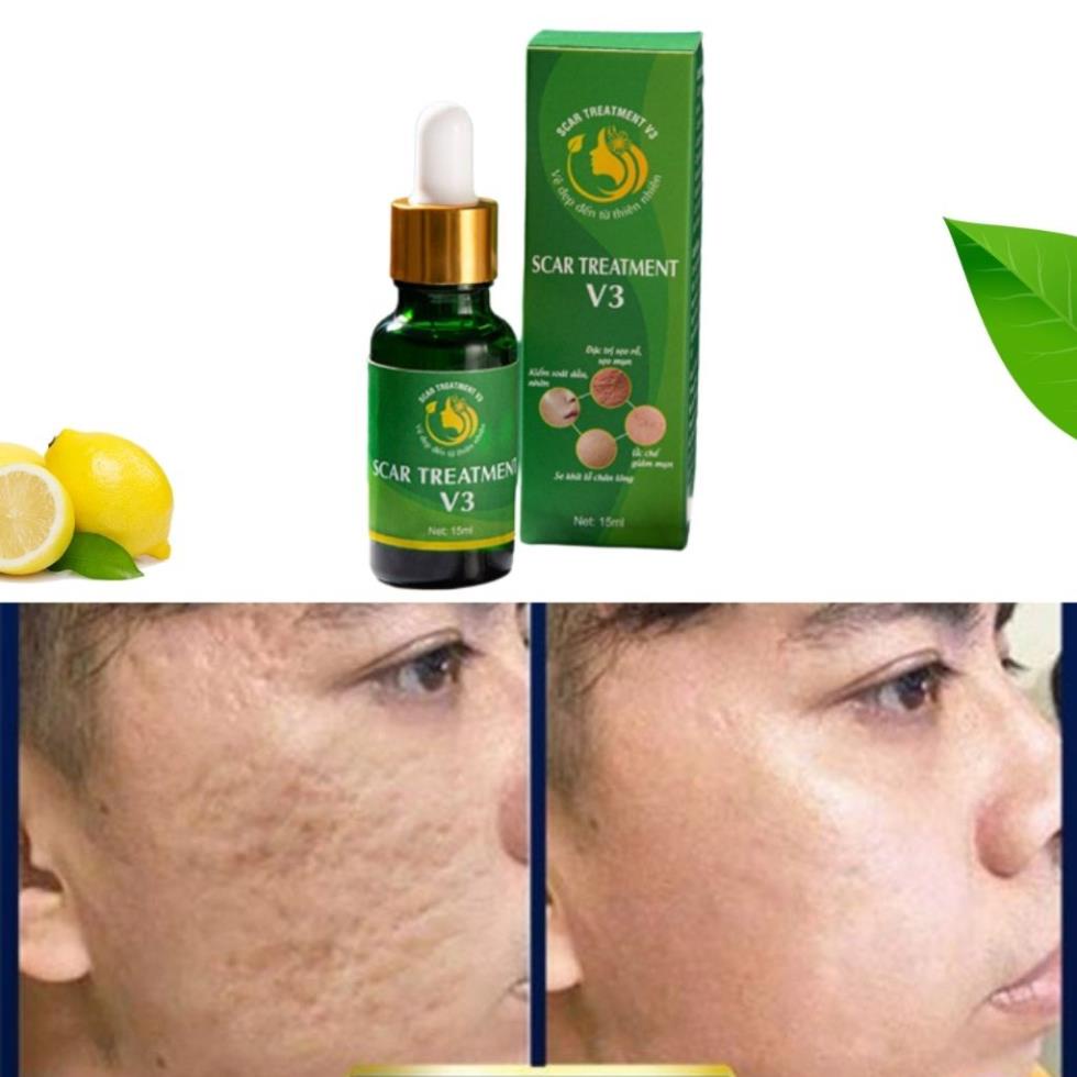 Tinh chất serum hỗ trợ sẹo lâu năm-Inviscar Streatment 15ml-Hiệu quả nhanh-Không gây kích ứng