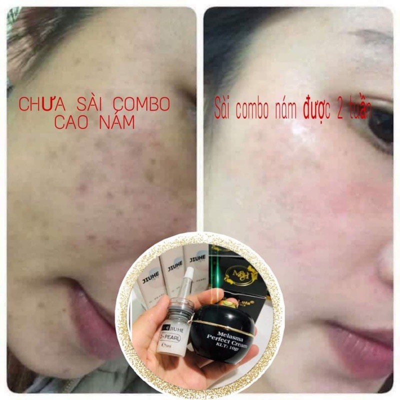 (HÀNG CHÍNH HÃNG 100%) COMBO SERUM JIUHE  THANH TÔ VÀ CAO NÁM BALLA LUTA