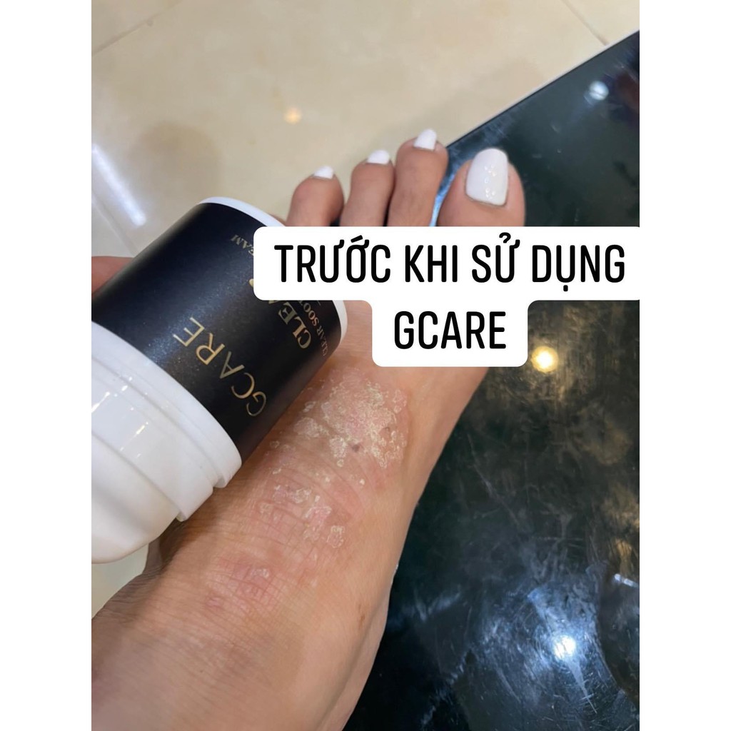 Kem bôi da liễu đa năng GCARE về các vấn đề mẩn ngứa viêm da công thức đến từ Anh Quốc.