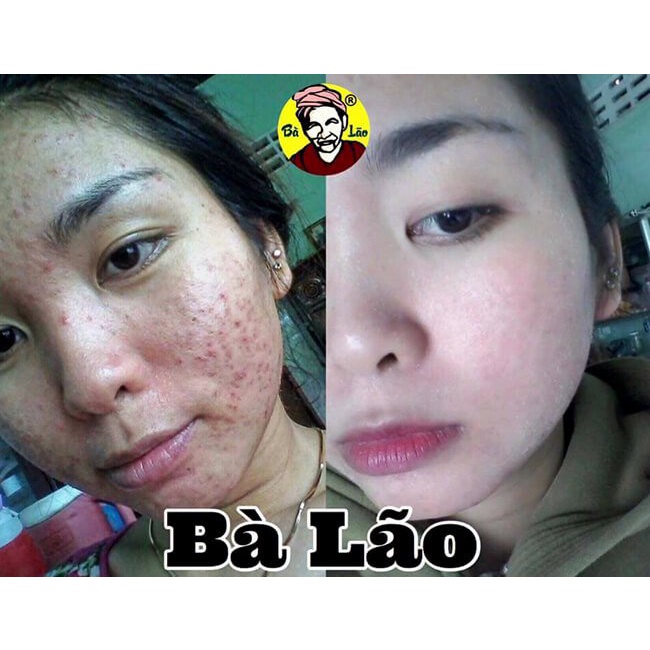 chính hãng) - SERUM MỤN BÀ LÃO - Tái Tạo Cao Cấp mẫu mới | BigBuy360 - bigbuy360.vn