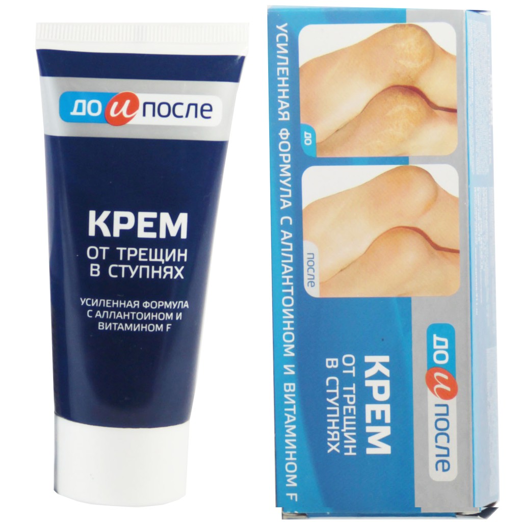 KEM TRỊ NỨT GÓT CHÂN NGA