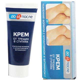 Kem trị nứt gót chân nga