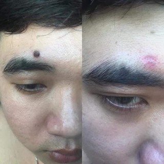 GEL TẨY NUỐT RUỒI NGA