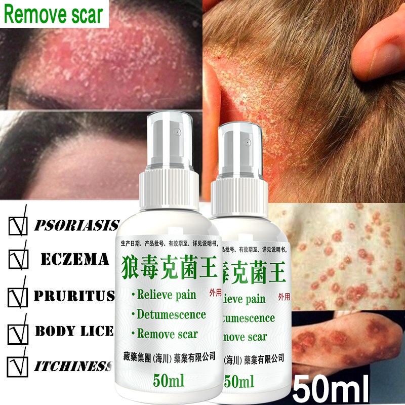 1 Chai Xịt Hỗ trợ giảm vẩy nến Eczma Chăm Sóc Da Toàn Diện