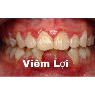 Viêm lợi chảy máuchânrăng