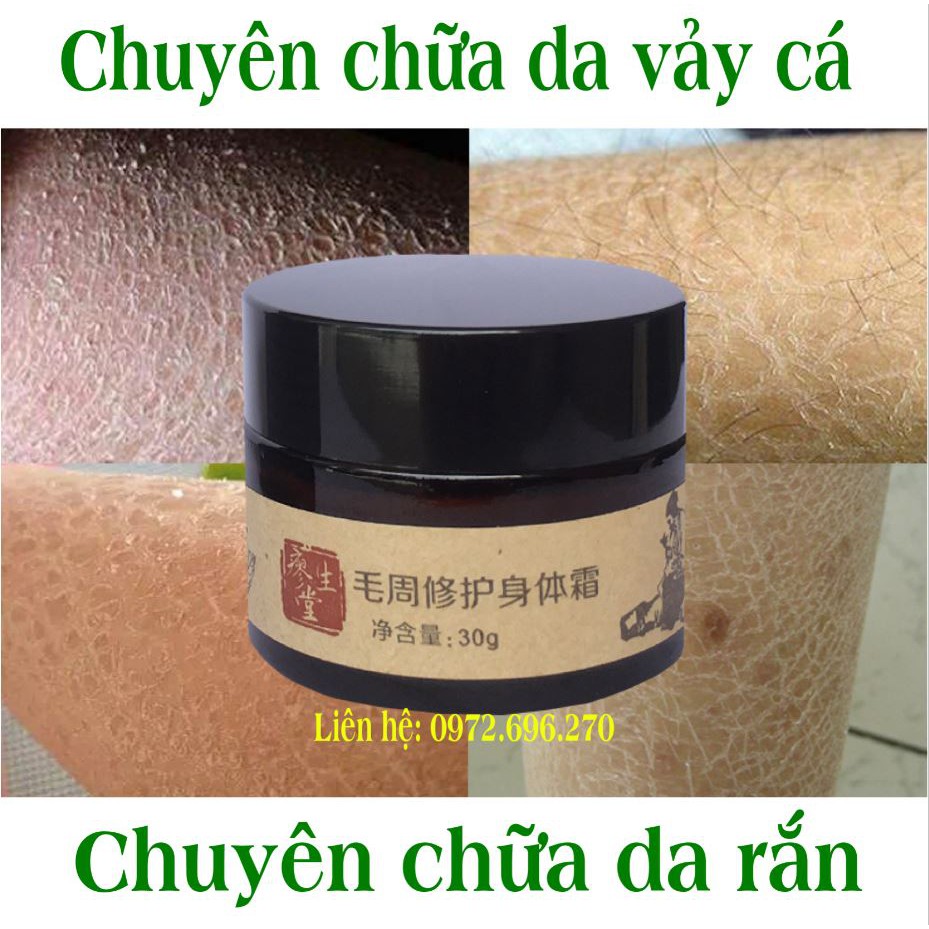 Kem bôi viêm nang lông - viêm lỗ chân lông [ Cực hiệu quả ] | BigBuy360 - bigbuy360.vn
