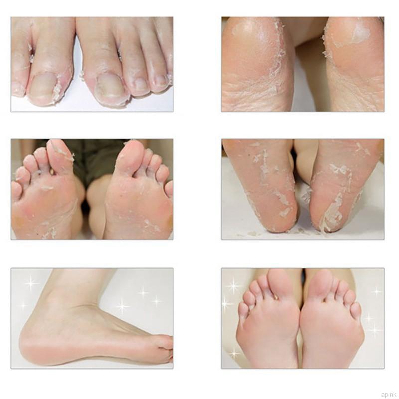 [Hàng mới về] Mặt nạ chân dạng lột loại bỏ tế bào da chết | BigBuy360 - bigbuy360.vn