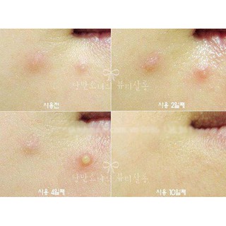 Chấm mụn bye bye blemish