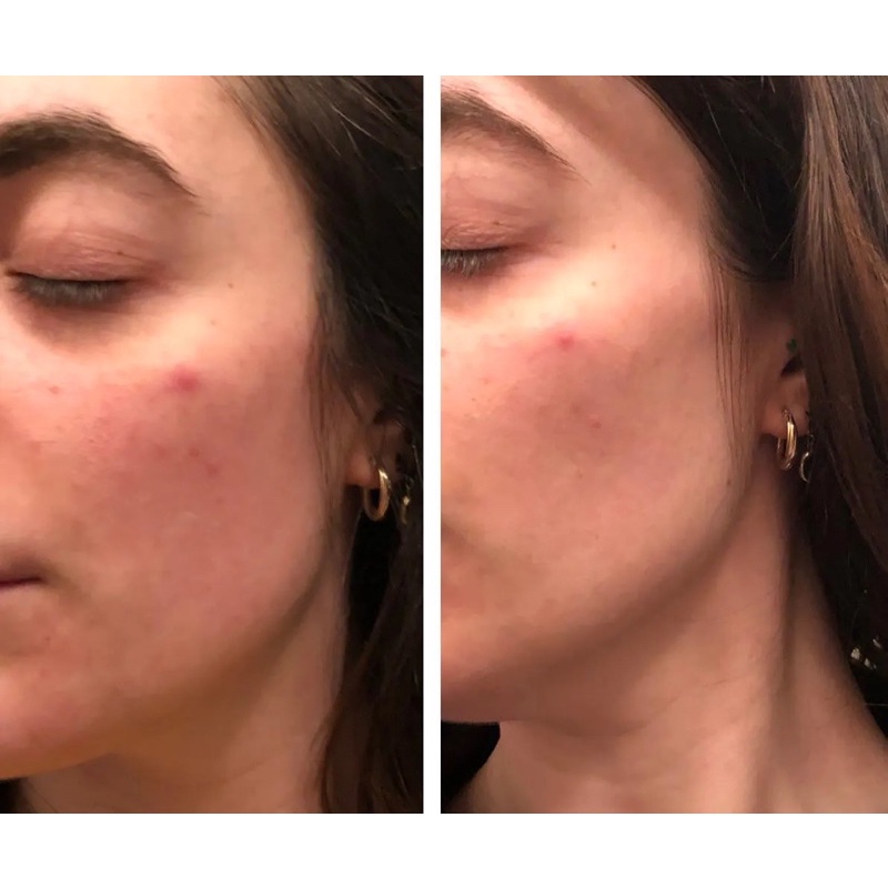 HYALURONIC ACID DƯỠNG ẨM VƯỢT TRỘI