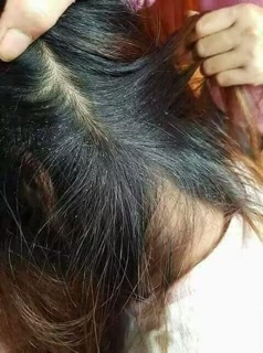 Dầu gội trị nấm trị chấy