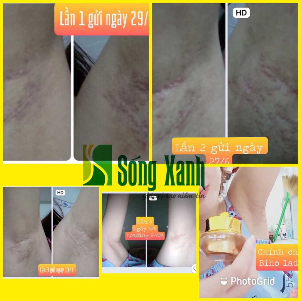 BIHO LADI [COMBO 5 HỘP] SIÊU DƯỠNG THÂM 5S (BIHO LADY - BIHOLADI NGĂN NGỪA THÂM NÁCH BẸN MÔNG BIKINI, LÀM TRẮNG DA) | BigBuy360 - bigbuy360.vn