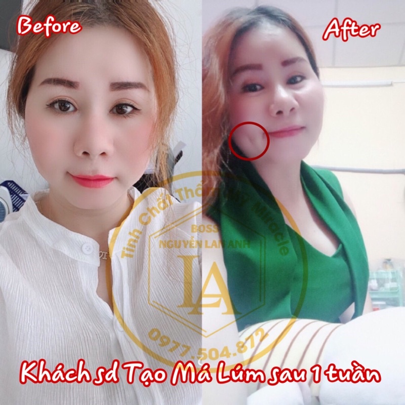 Tinh Chất Tạo Má Núm Đồng Tiền Miracle