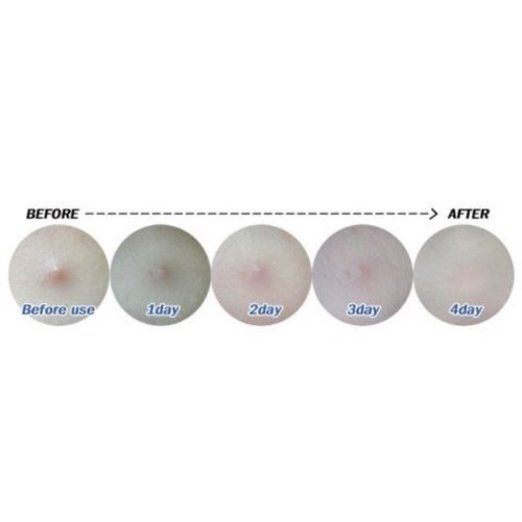 Miếng dán mụn MISSHA  ANTI TROUBLE PATCH