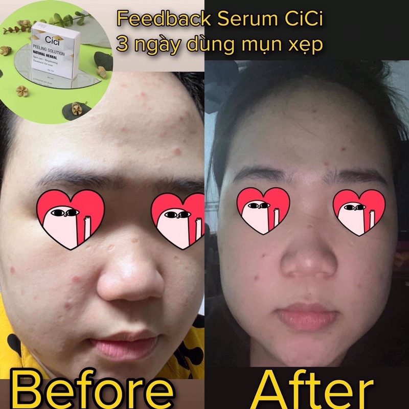HỘP SERUM MỤN🌱
