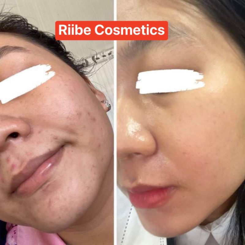 SERUM RIIBE  tặng 30ml sữa rửa mặt riibe +quà