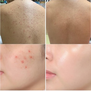 TINH DẦU CHẤM MỤN SOMEBYMI TEA TREE CLEAR SPOT OIL