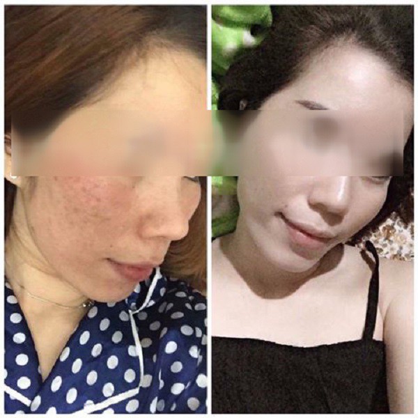 Combo an dược sơn 30ml và bột rửa mặt