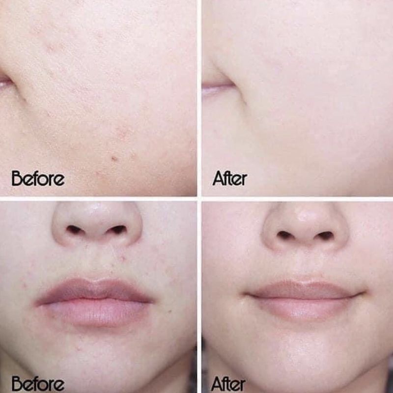 Kem Dưỡng SVR giúp kiềm dầu & se khít lcl dành cho da dầu mụn