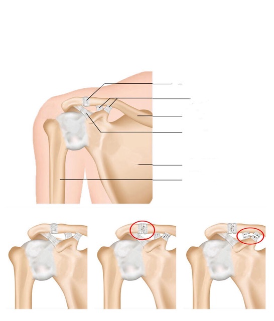 Đai cố định vai , hỗ trợ ổn định chấn thương vùng vai