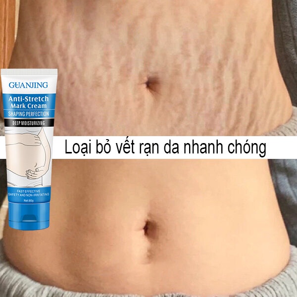 Kem xóa sẹo rạn da, kem làm mờ vết rạn da do béo phì, kem phục hồi da