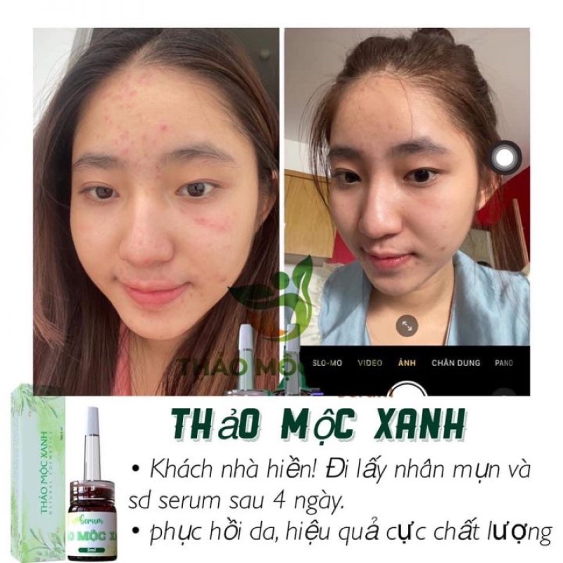 [COMBO] Căng Bóng Sạch Mụn Thảo Mộc Xanh