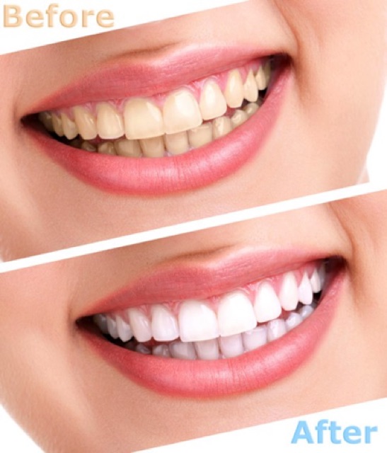 Bộ làm trắng răng White Glo White Accelerator Blue Light Teeth Whitening System