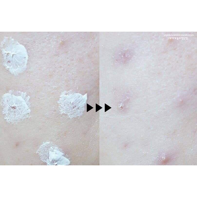 𝐊𝐞𝐦 𝐇𝐨̂̃ 𝐓𝐫𝐨̛̣ 𝐆𝐢𝐚̉𝐦 𝐌𝐮̣𝐧 #Ciracle Red Spot (chính hãng, date 2023)