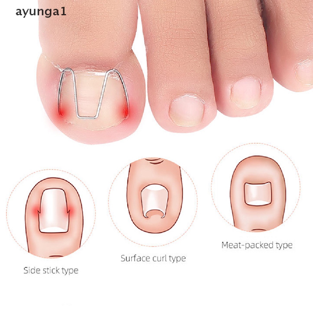 [ayunga1] Nail Art Ingrown Toe Nail Correction Tool Toenail Nail Orthosis Paronychia Clip [new]