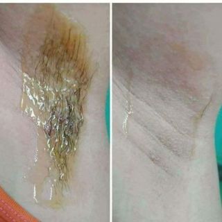 Combo triệt lông vĩnh viễn