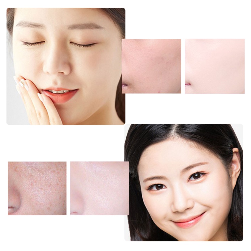 Kem Hỗ trợ giảm tàn nhang Làm Trắng Da Dưỡng Ẩm 15g