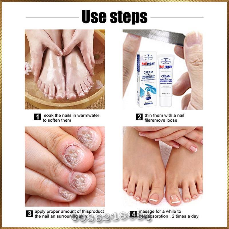 Kem nấm móng Aichun Nail Repair Cream phục hồi nấm móng tay móng chân A4719