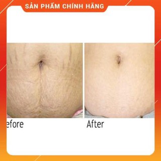 [Hàng Xịn] Trị Rạn Da - FIXDERMA PREGGERS STRETCH MARK CREAM