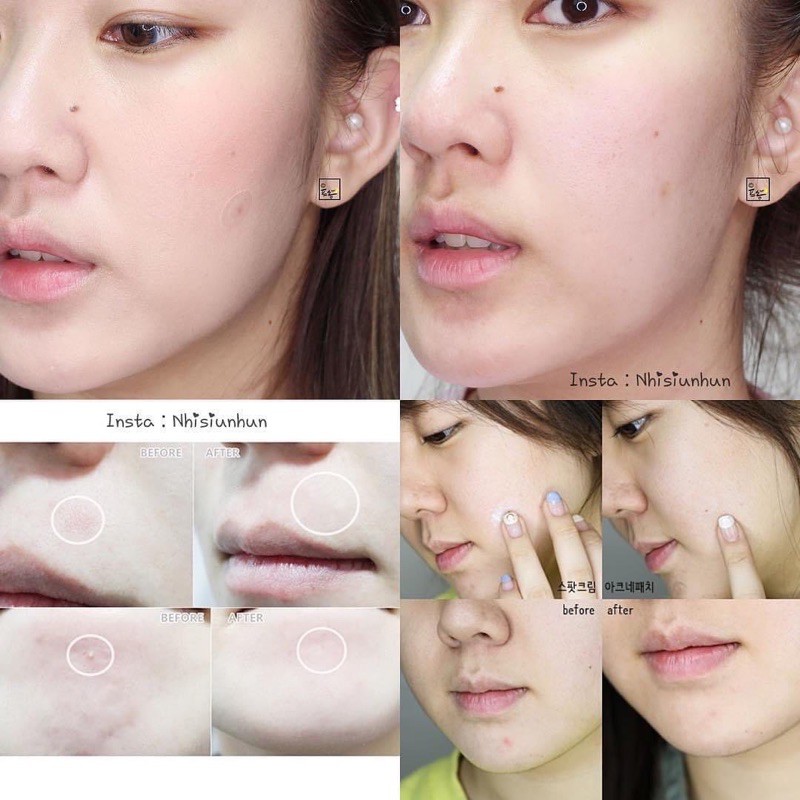 Miếng dán hút mụn Cosrx Acne Pimple Master Patch Cosrx