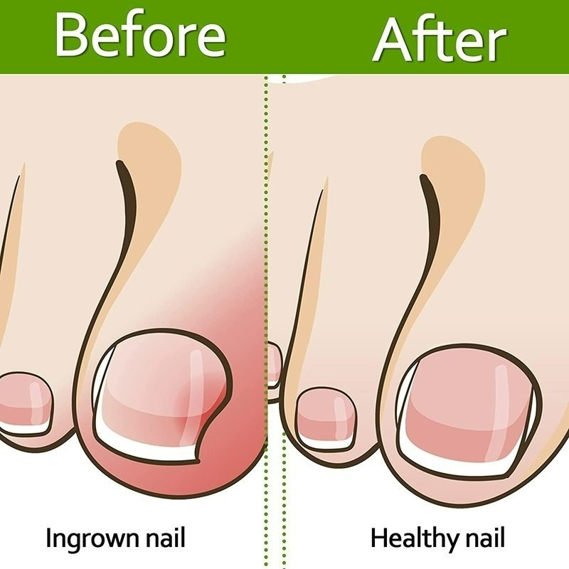 Hộp 1 Hộp Miếng Đệm Co Giãn Chỉnh Sửa Móng Chân Mọc Ngược Trong Suốt Dùng 1 Lần