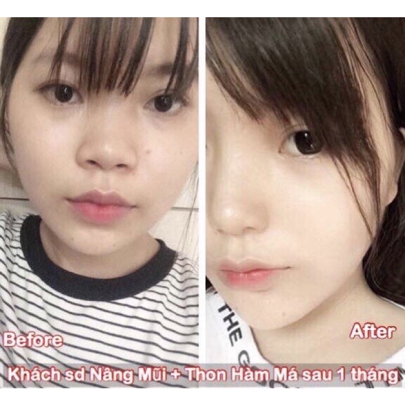 Tinh chất thu xương hàm má Miracle, hiệu quả chỉ sau 14 ngày