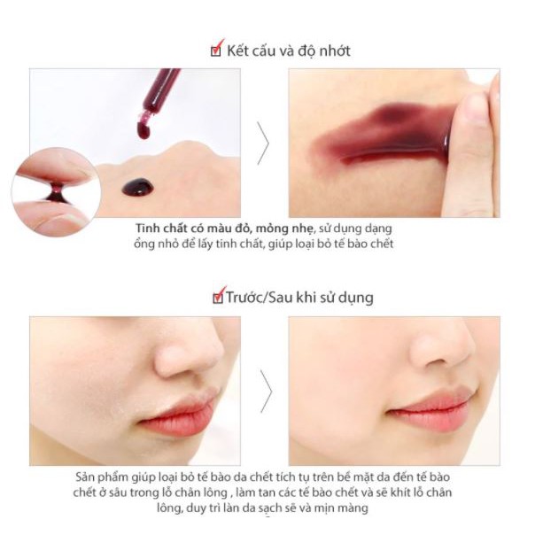 Tinh Chất Tẩy Da Chết Hóa Học So' Natural Red Peel Tingle Serum 35ml | BigBuy360 - bigbuy360.vn