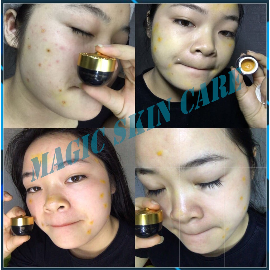 Kem Nghệ Ngừa THÂM Magicskin SIÊU PHẨM ngừa THÂM SẸO VẾT THƯƠNG NGOÀI DA