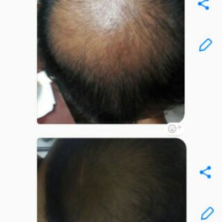 Neo Hair Lotion (Chuyên sỉ)