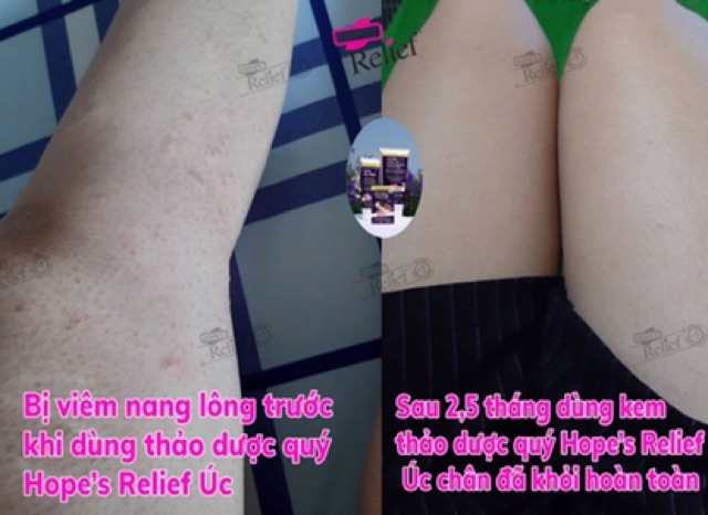 [DEAL SỐC] Kem đa năng dưỡng ẩm, hỗ trợ phục hồi da khô, ngứa Hope’s Relief 60g | BigBuy360 - bigbuy360.vn