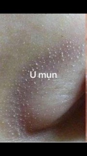 Ủ MỤN ĐẦU ĐEN YOUNGERC
