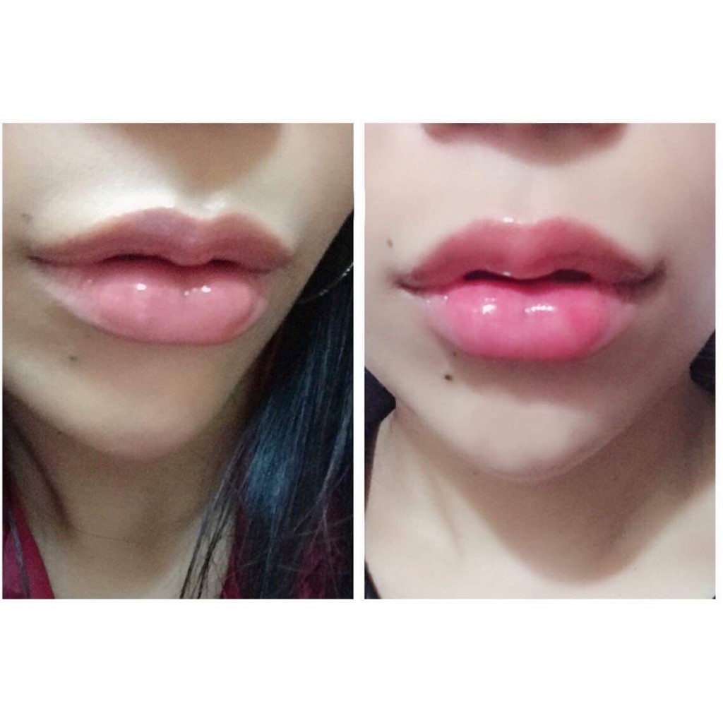 [FREESHIP] Kem khử thâm làm hồng môi Hàn Quốc Xxvirgin 5ml có tác dụng sau 5 ngày | BigBuy360 - bigbuy360.vn