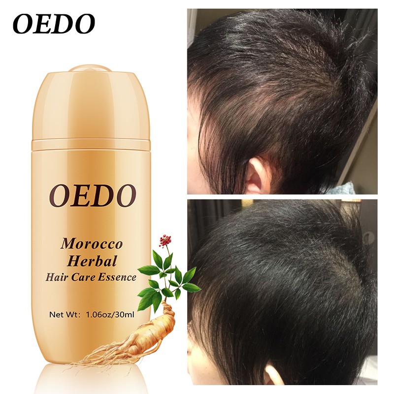 OEDO Tinh chất chăm sóc tóc nhân sâm thảo dược Morocco rụng tóc cho nam và nữ nhanh chóng tăng trưởng mạnh mẽ Serum sửa chân tóc | BigBuy360 - bigbuy360.vn